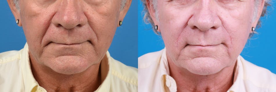 Nasolabial Folds Before & After Gallery - Patient 122406428 - Image 2