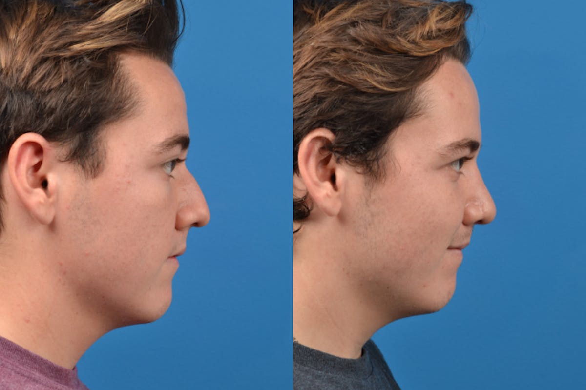 Male Rhinoplasty Before & After Gallery - Patient 122406430 - Image 2