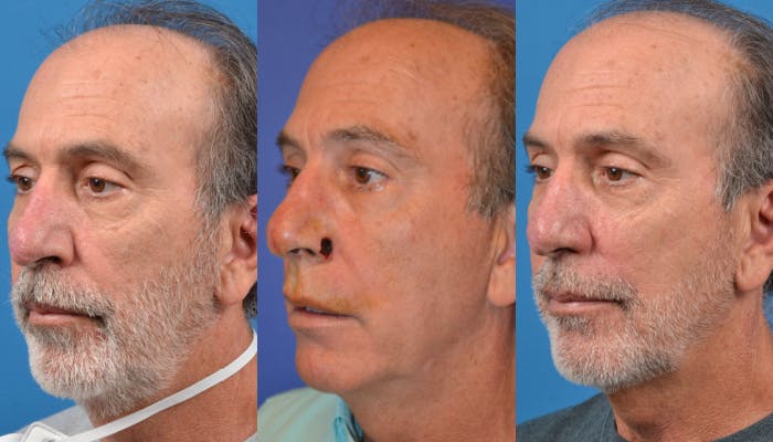 Mohs Surgery and Skin Cancer Before & After Gallery - Patient 122406427 - Image 1
