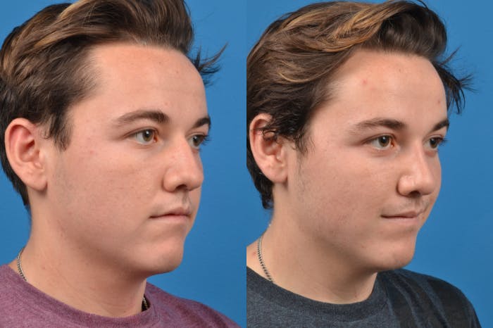 Male Rhinoplasty Before & After Gallery - Patient 122406430 - Image 3
