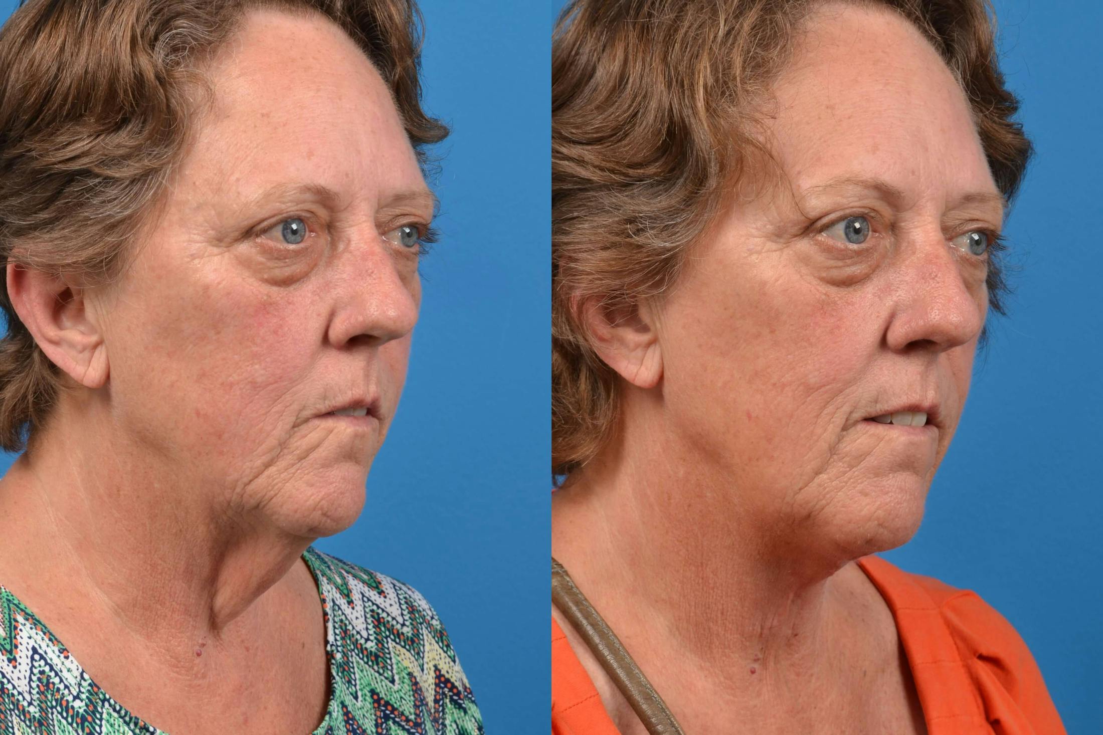 Profile Neck Lift Before & After Gallery - Patient 122406433 - Image 3