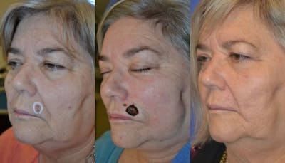 Mohs Surgery and Skin Cancer Before & After Gallery - Patient 122406429 - Image 1