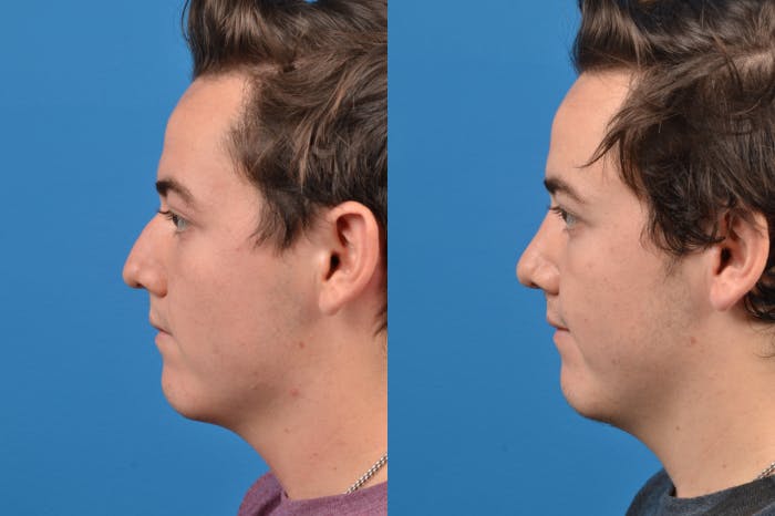 Male Rhinoplasty Before & After Gallery - Patient 122406430 - Image 4
