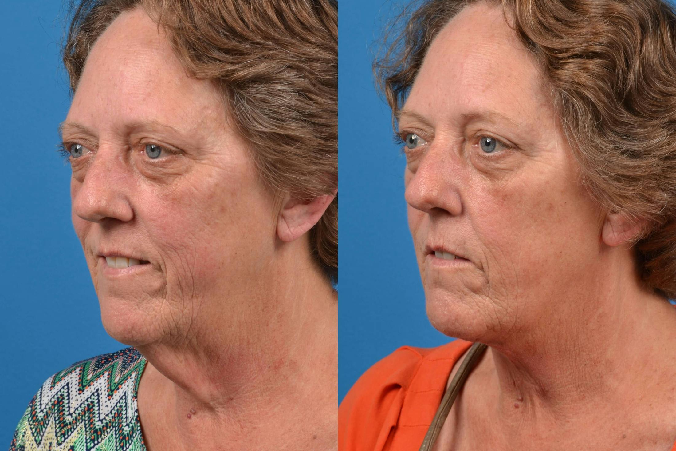 Profile Neck Lift Before & After Gallery - Patient 122406433 - Image 4