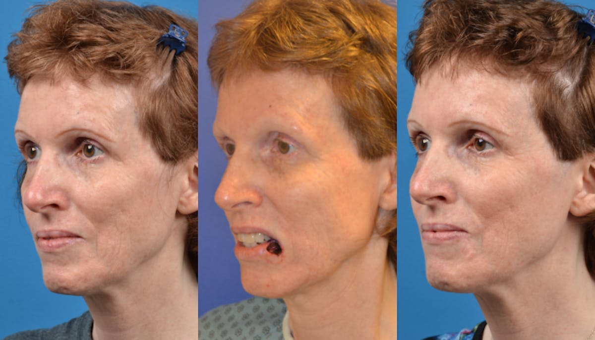 Mohs Surgery and Skin Cancer Before & After Gallery - Patient 122406432 - Image 1