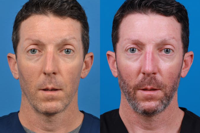 Male Rhinoplasty Before & After Gallery - Patient 122406436 - Image 1