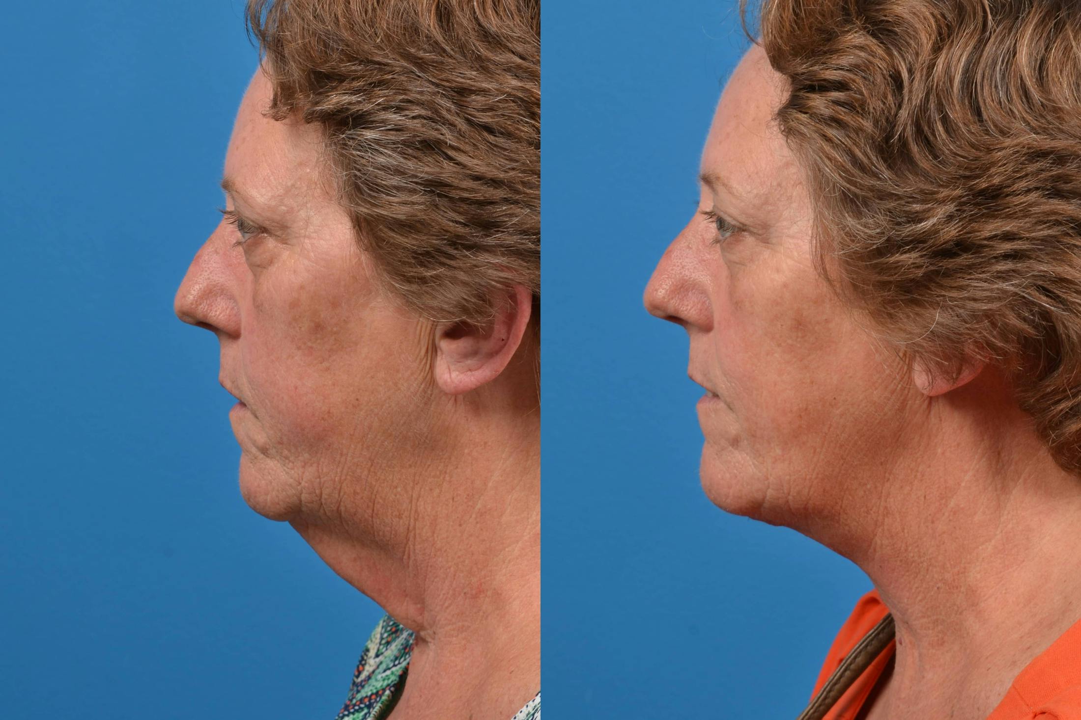 Profile Neck Lift Before & After Gallery - Patient 122406433 - Image 5