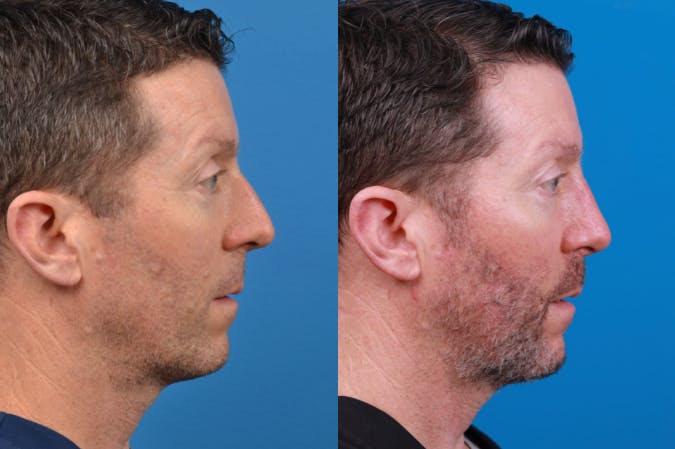 Male Rhinoplasty Before & After Gallery - Patient 122406436 - Image 2