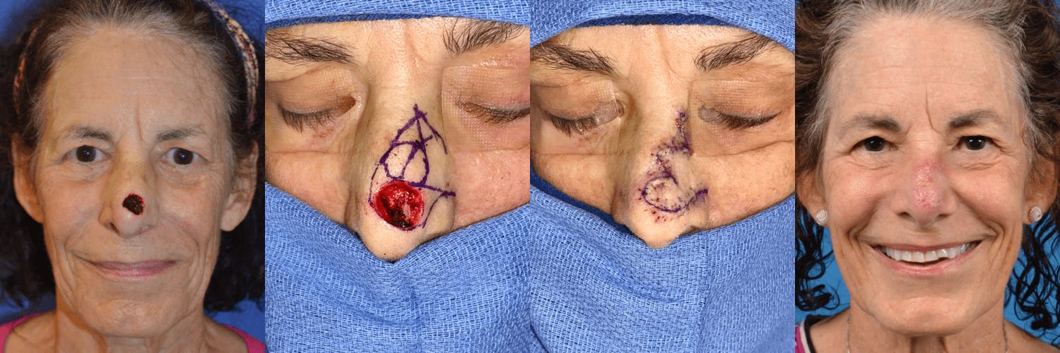Mohs Surgery and Skin Cancer Before & After Gallery - Patient 122406434 - Image 1