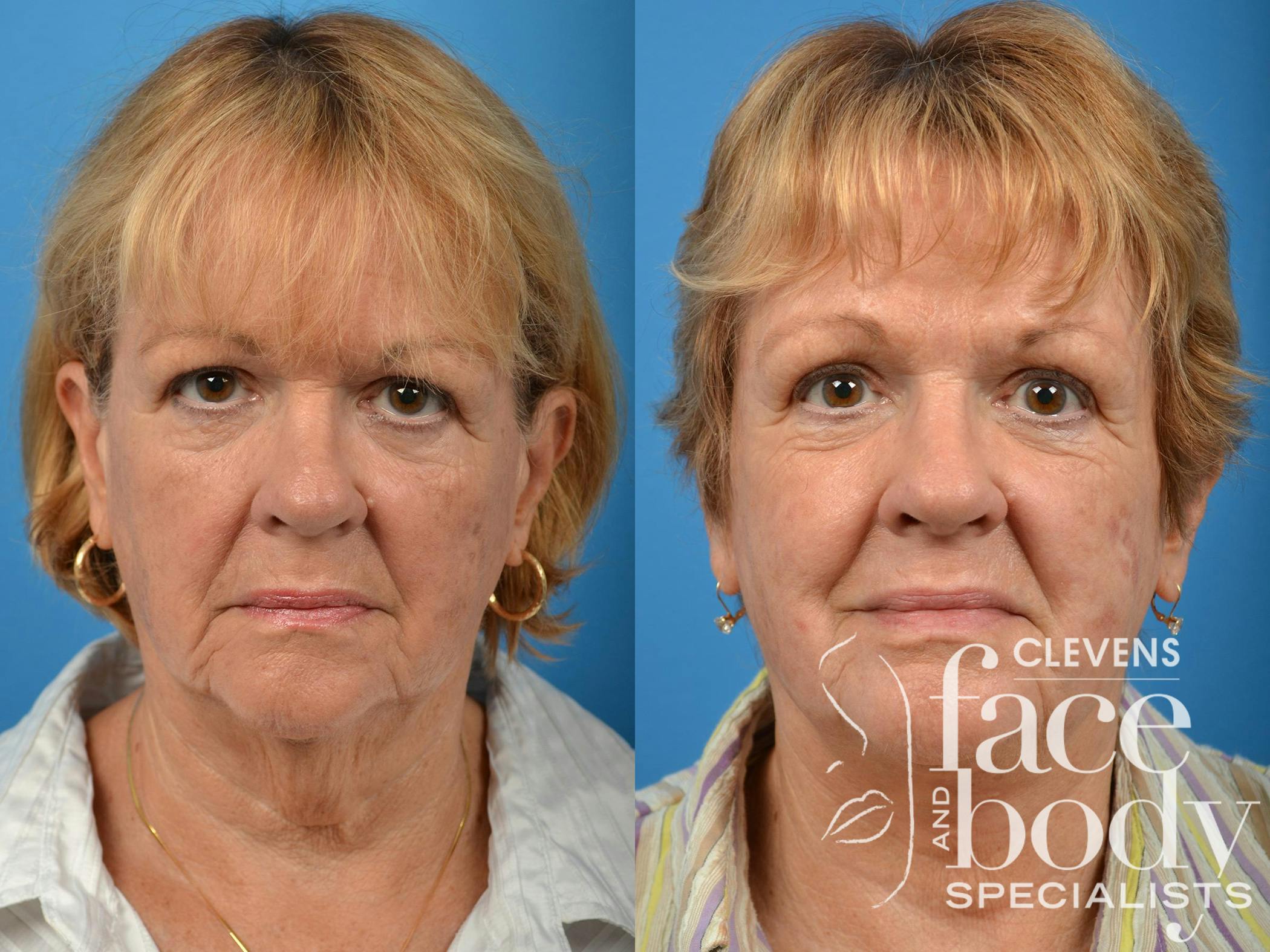 Neck Lift