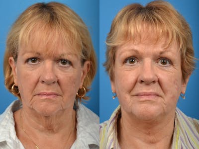 Profile Neck Lift Before & After Gallery - Patient 122406439 - Image 1