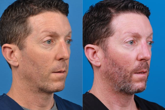 Male Rhinoplasty Before & After Gallery - Patient 122406436 - Image 3