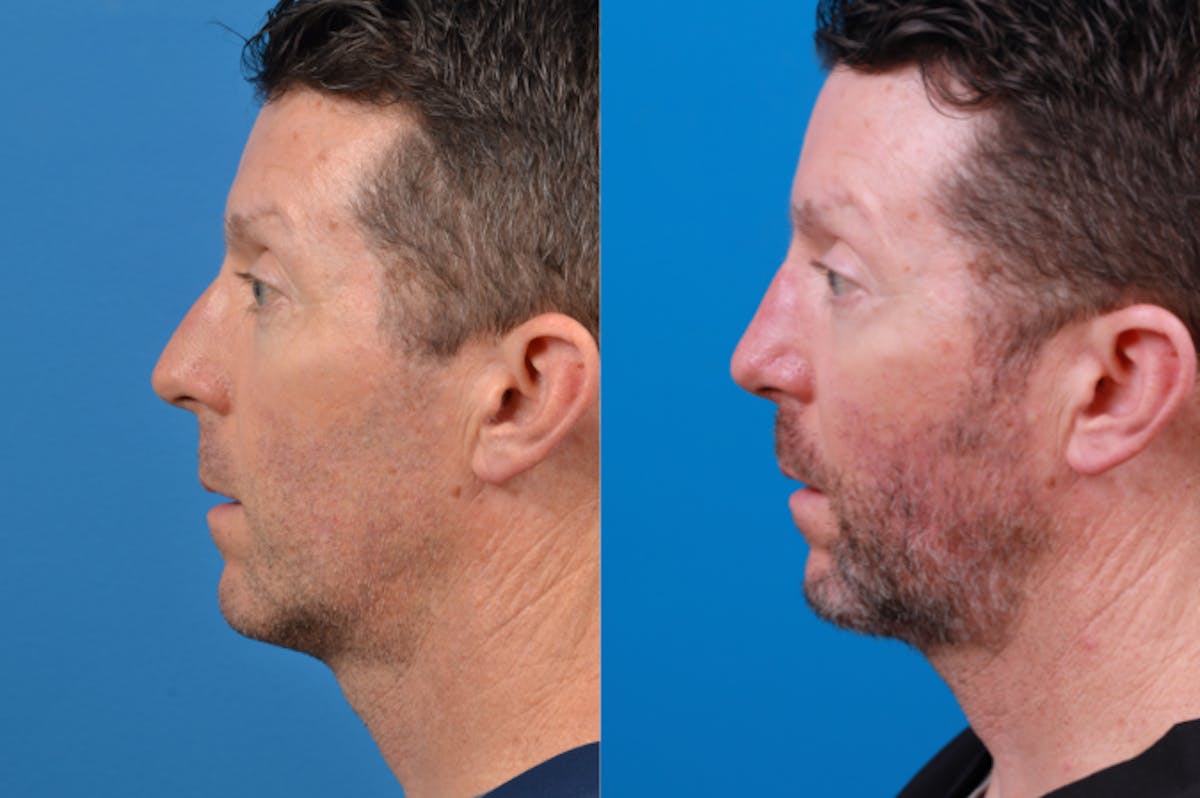 Male Rhinoplasty Before & After Gallery - Patient 122406436 - Image 4
