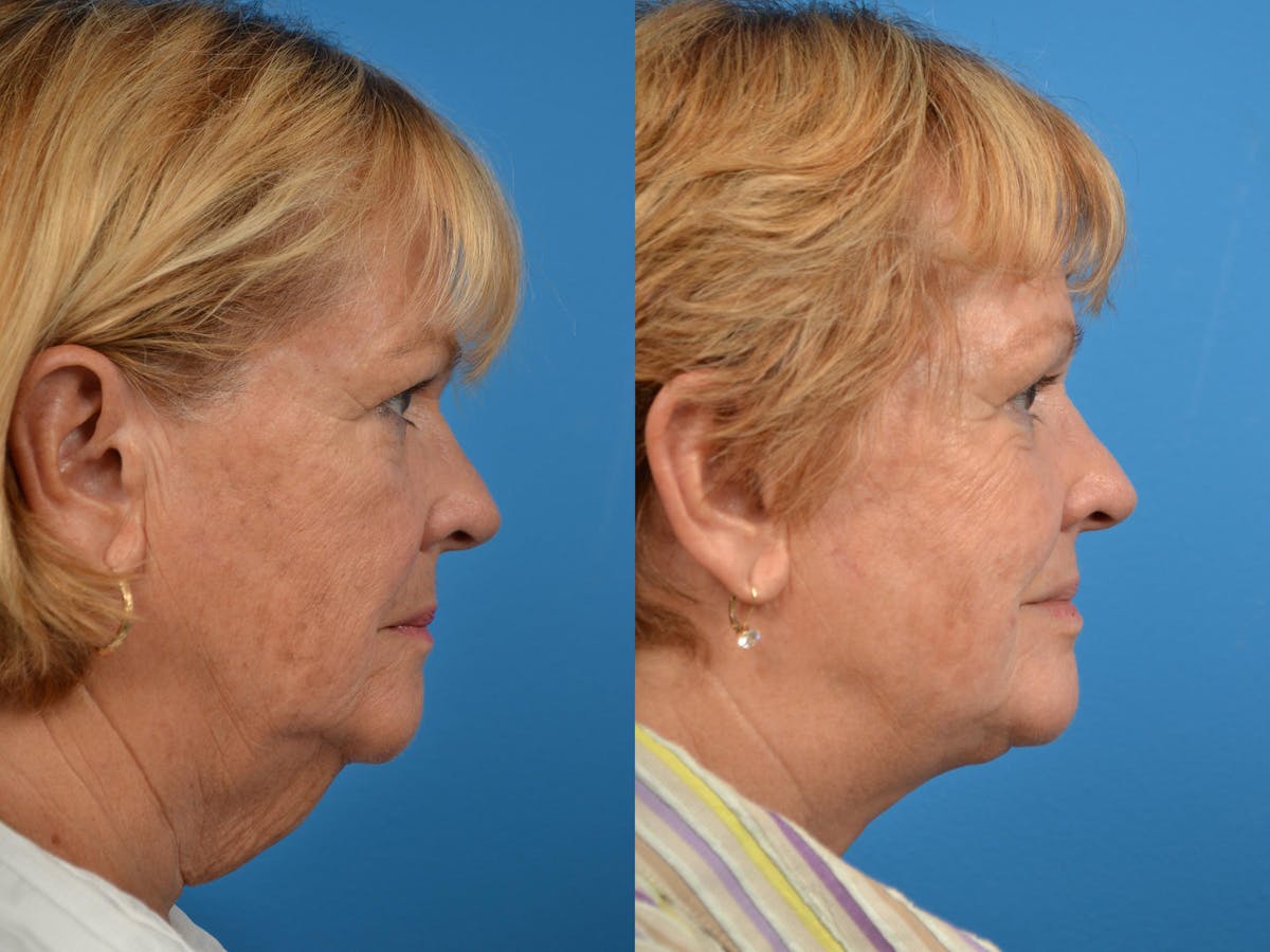 Profile Neck Lift Before & After Gallery - Patient 122406439 - Image 2