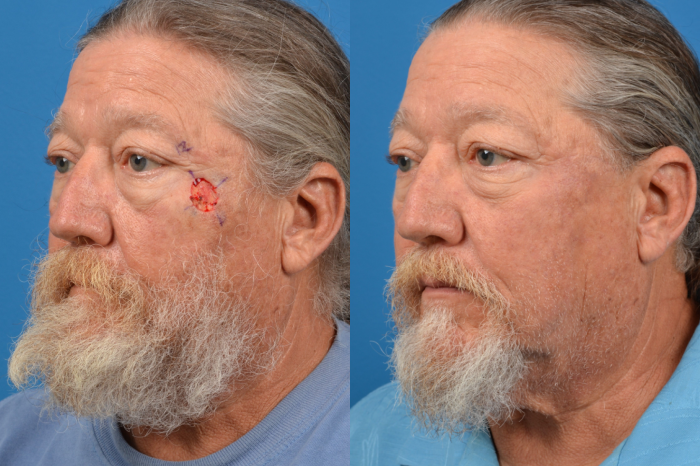 Mohs Surgery and Skin Cancer Before & After Gallery - Patient 122406435 - Image 1