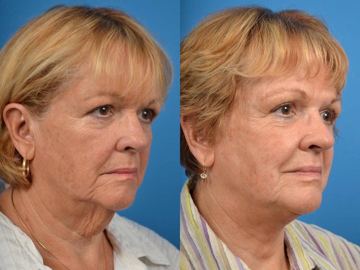 Profile Neck Lift Before & After Gallery - Patient 122406439 - Image 3