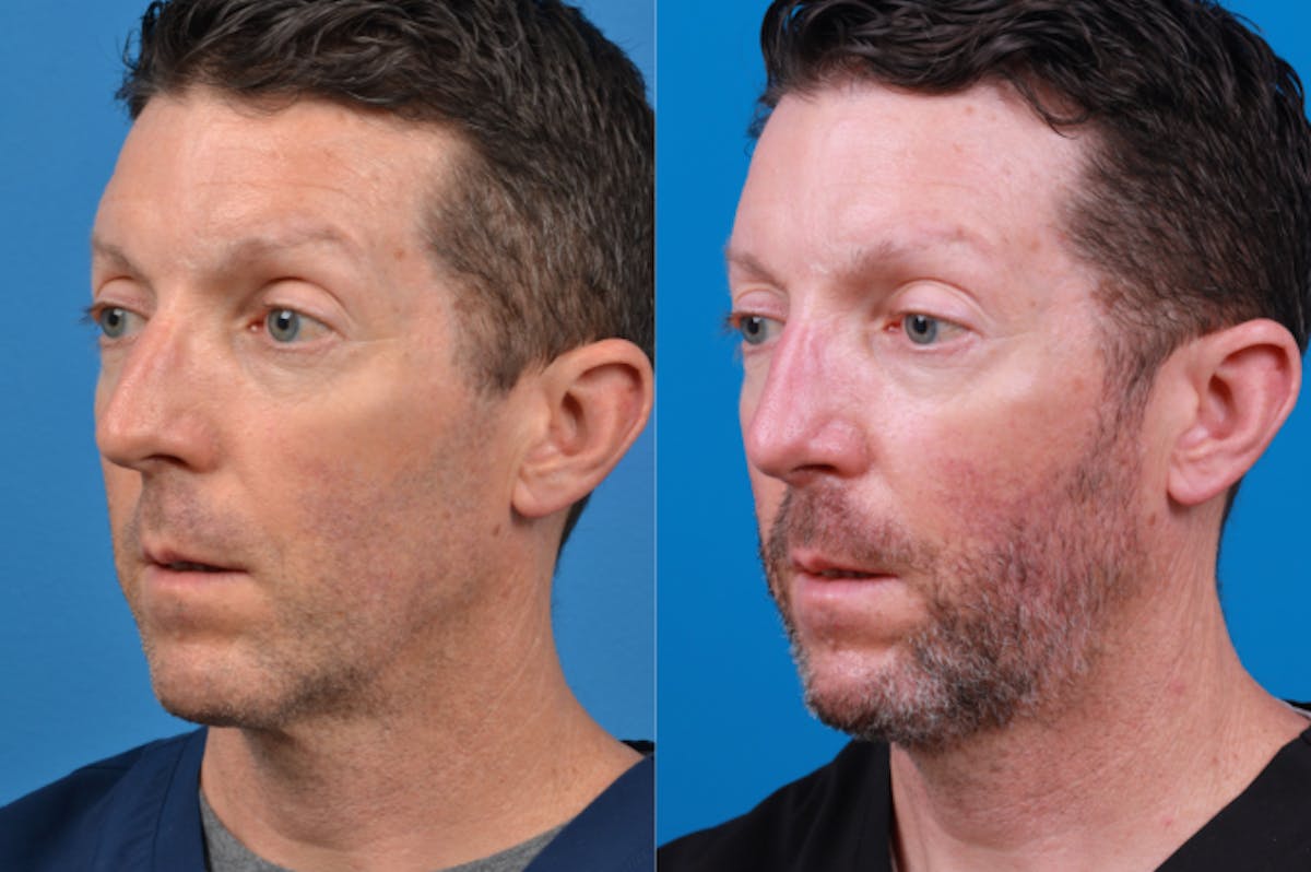 Male Rhinoplasty Before & After Gallery - Patient 122406436 - Image 5
