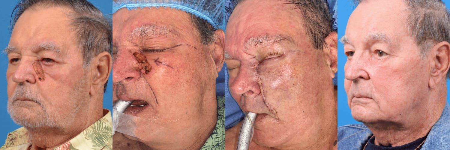 Mohs Surgery and Skin Cancer Before & After Gallery - Patient 122406437 - Image 1