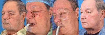 Mohs Surgery and Skin Cancer Before & After Gallery - Patient 122406437 - Image 1