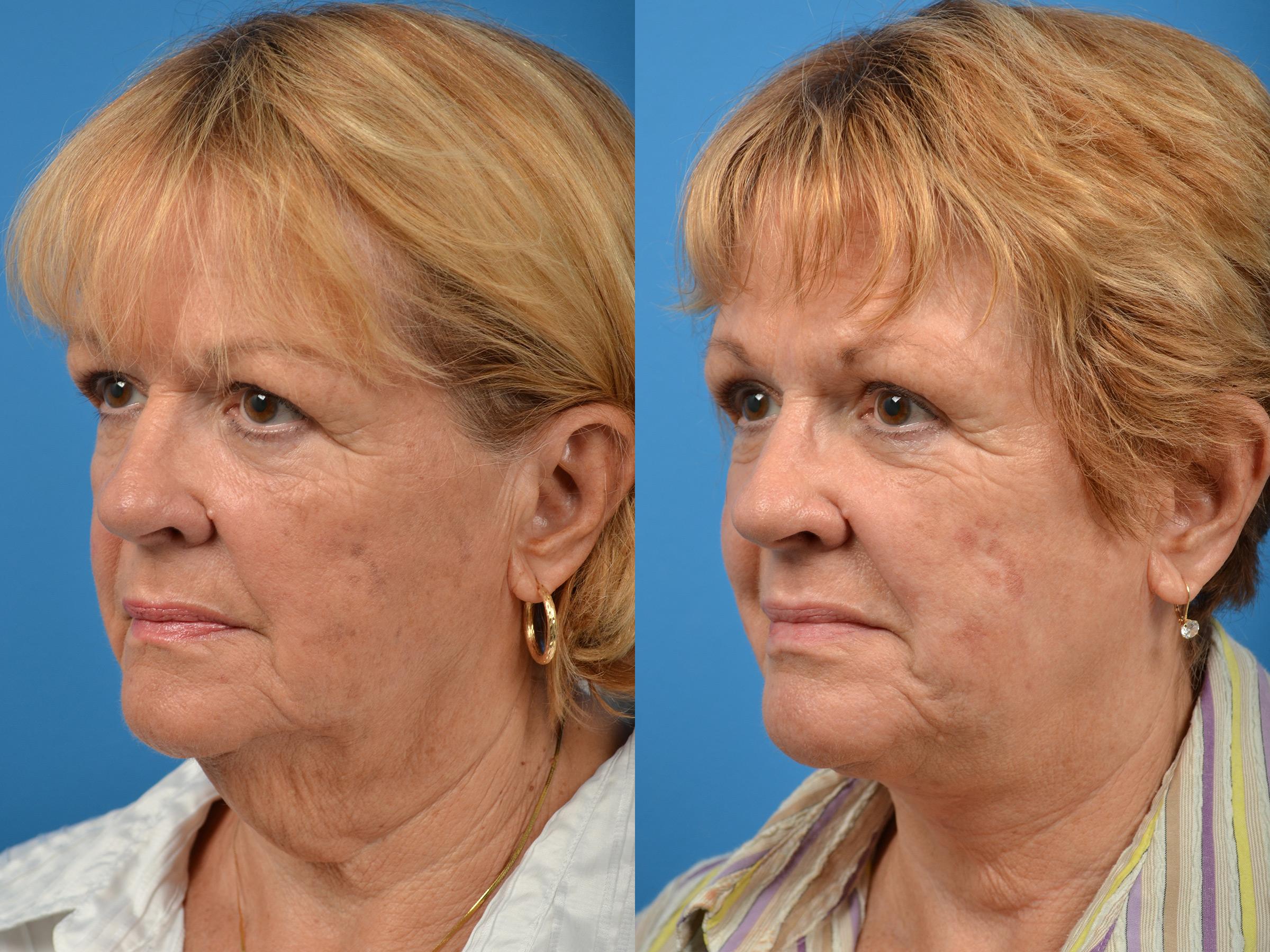 Profile Neck Lift Before & After Gallery - Patient 122406439 - Image 4