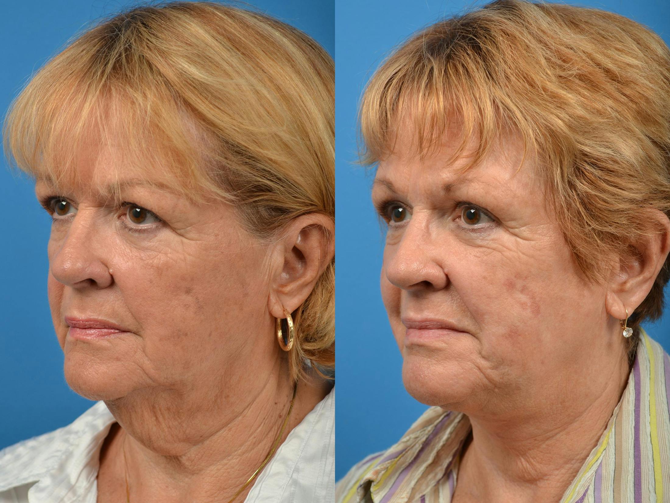 Profile Neck Lift Before & After Gallery - Patient 122406439 - Image 4