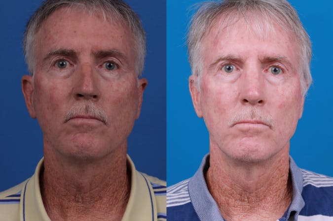 Male Rhinoplasty Before & After Gallery - Patient 122406442 - Image 1