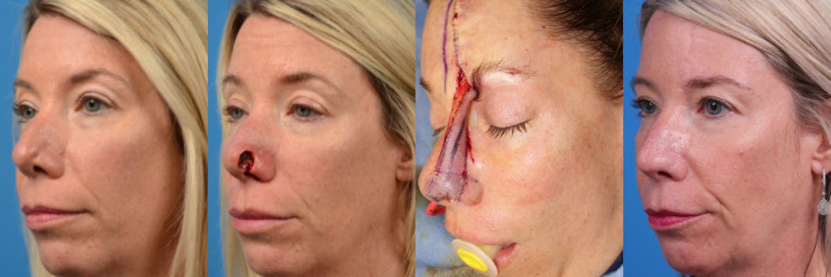 Mohs Surgery and Skin Cancer Before & After Gallery - Patient 122406438 - Image 1