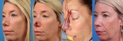 Mohs Surgery and Skin Cancer Before & After Gallery - Patient 122406438 - Image 1