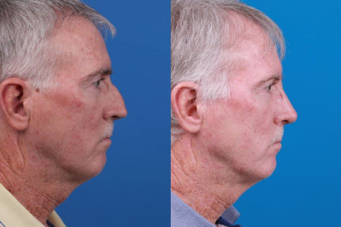 Male Rhinoplasty Before & After Gallery - Patient 122406442 - Image 2