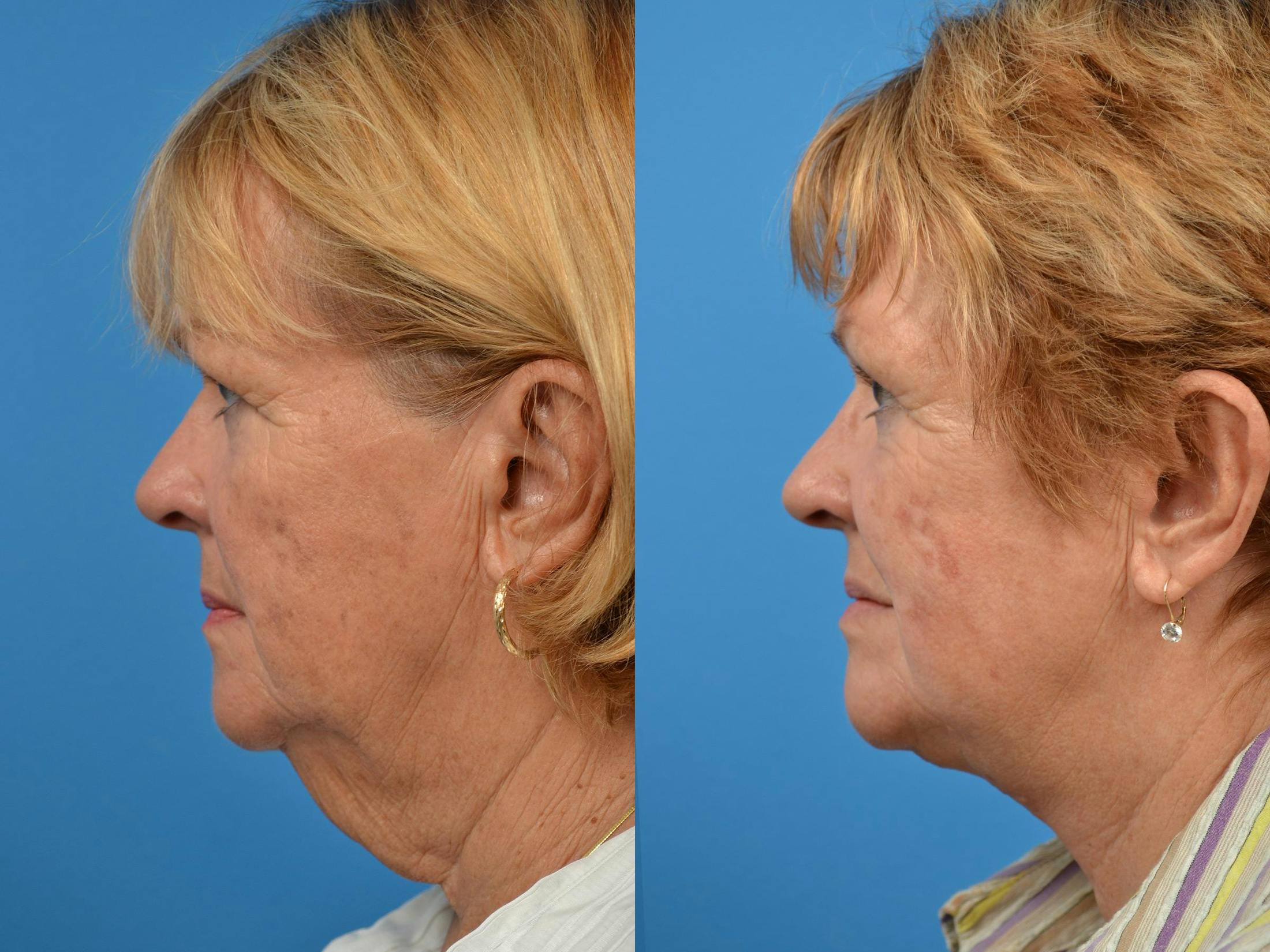 Profile Neck Lift Before & After Gallery - Patient 122406439 - Image 5