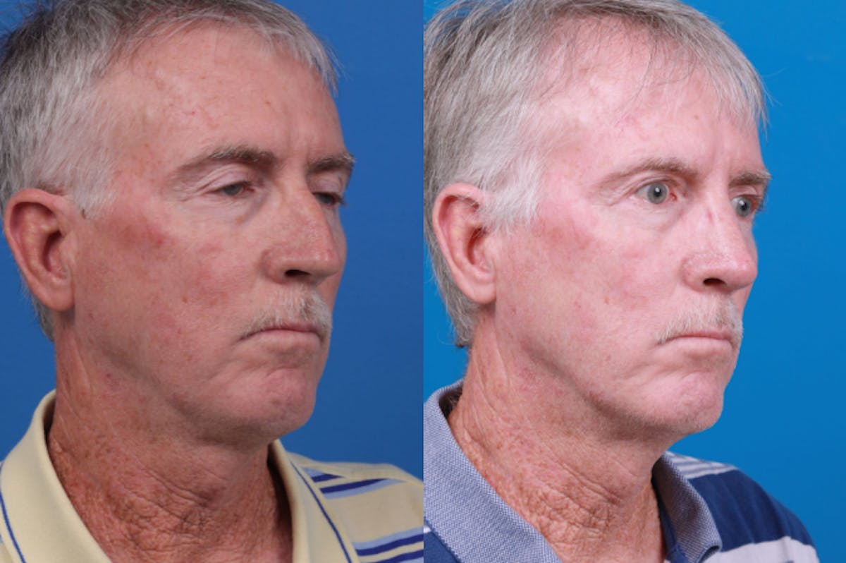 Male Rhinoplasty Before & After Gallery - Patient 122406442 - Image 3