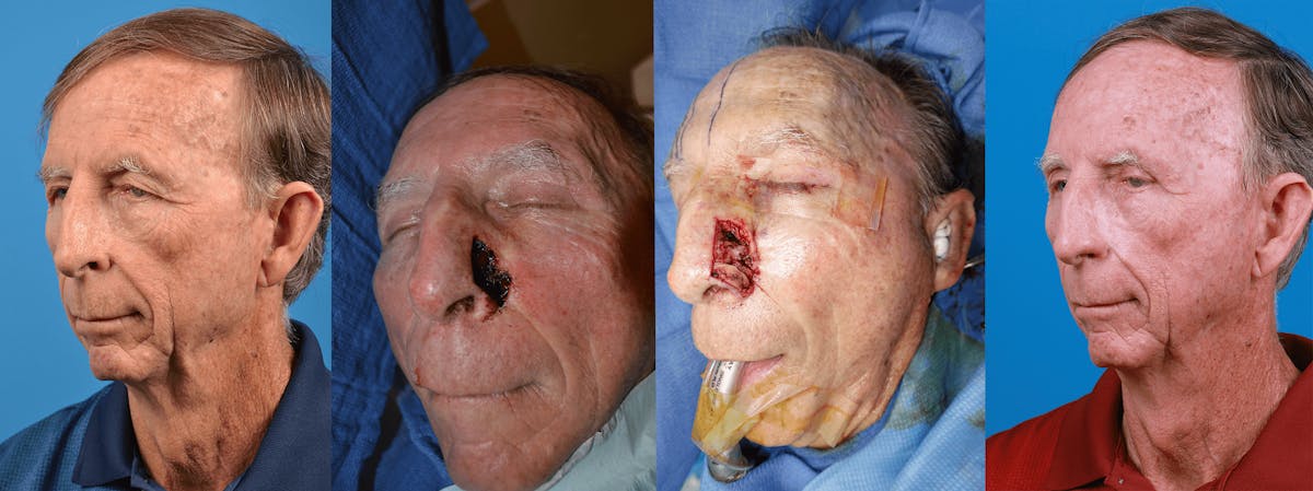 Mohs Surgery and Skin Cancer Before & After Gallery - Patient 122406440 - Image 1
