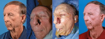 Mohs Surgery and Skin Cancer Before & After Gallery - Patient 122406440 - Image 1