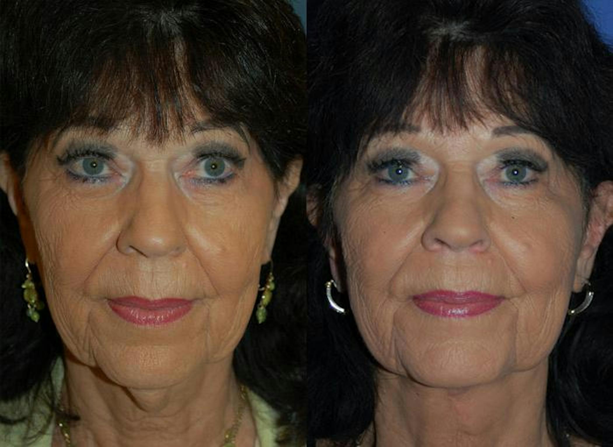 Signature Profile Neck Lift