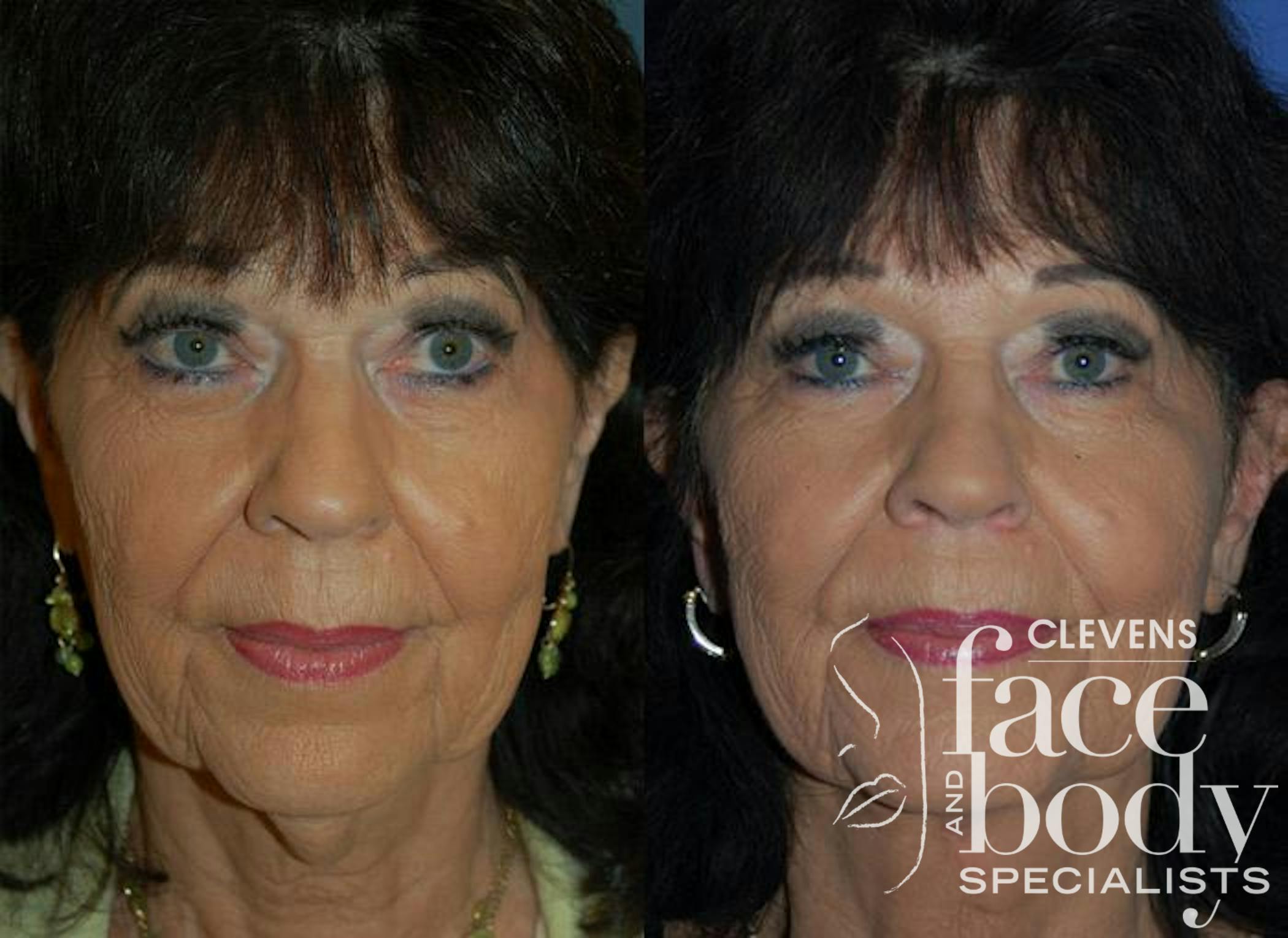 Signature Profile Neck Lift