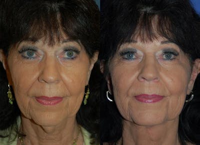 Profile Neck Lift Before & After Gallery - Patient 122406441 - Image 1