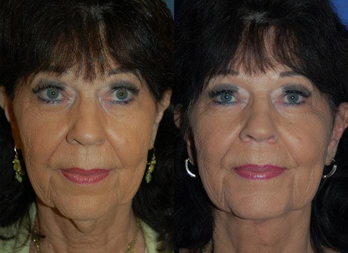 Profile Neck Lift Before & After Gallery - Patient 122406441 - Image 1