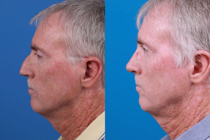 Male Rhinoplasty Before & After Gallery - Patient 122406442 - Image 4