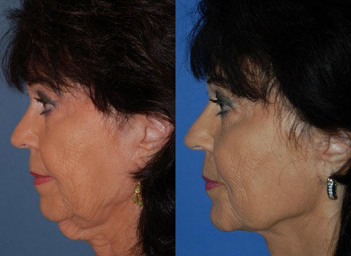 Profile Neck Lift Before & After Gallery - Patient 122406441 - Image 2