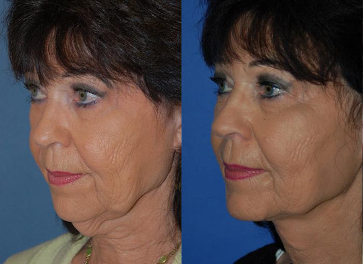 Profile Neck Lift Before & After Gallery - Patient 122406441 - Image 3