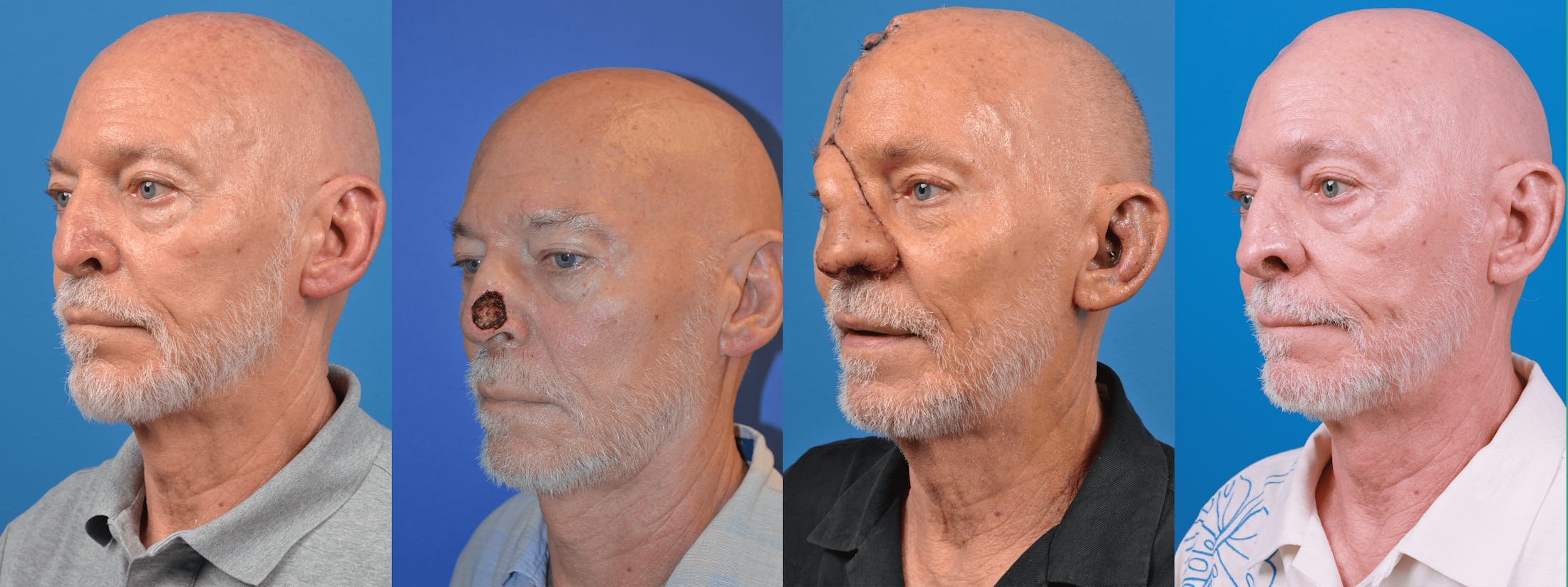Mohs Surgery and Skin Cancer Before & After Gallery - Patient 122406443 - Image 1
