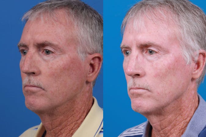 Male Rhinoplasty Before & After Gallery - Patient 122406442 - Image 5