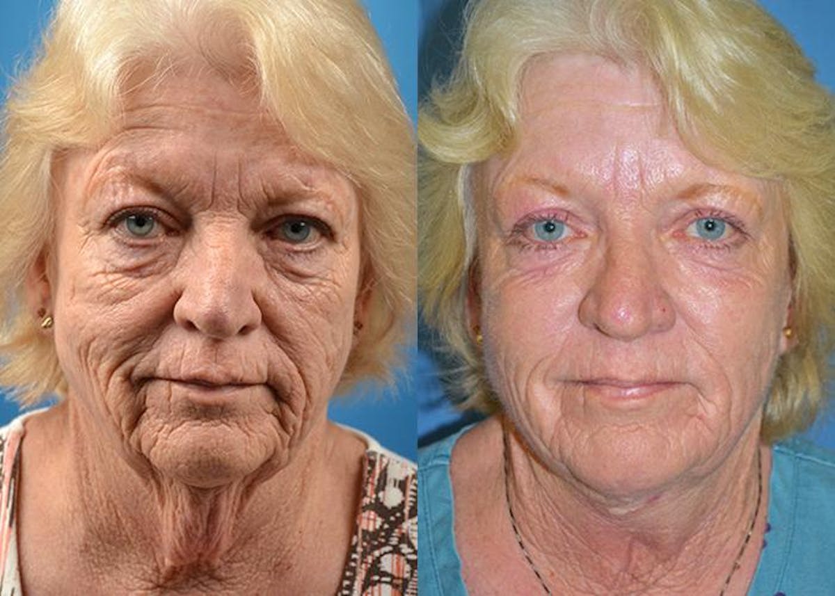 Profile Neck Lift Before & After Gallery - Patient 122406444 - Image 1