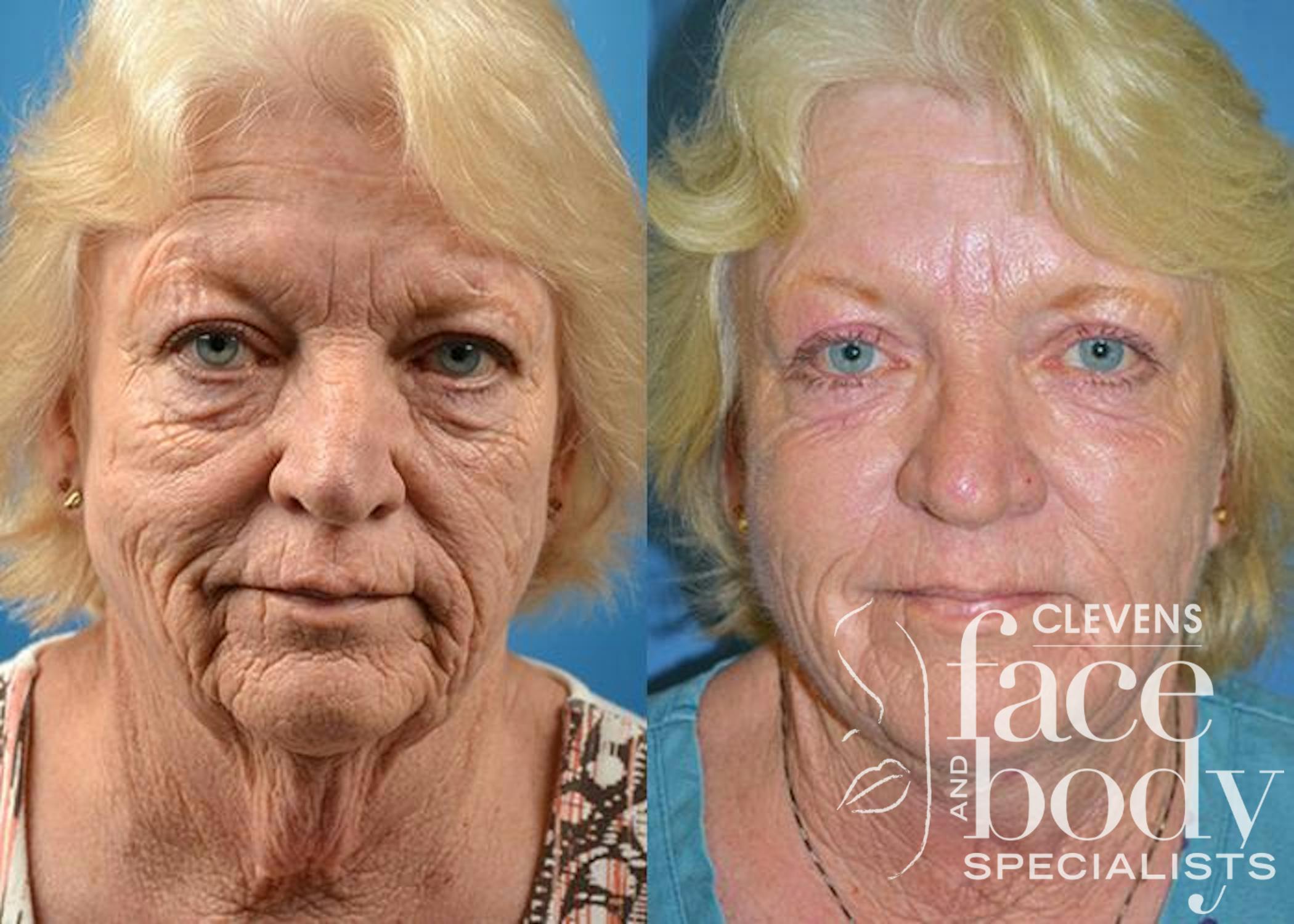 Neck Lift