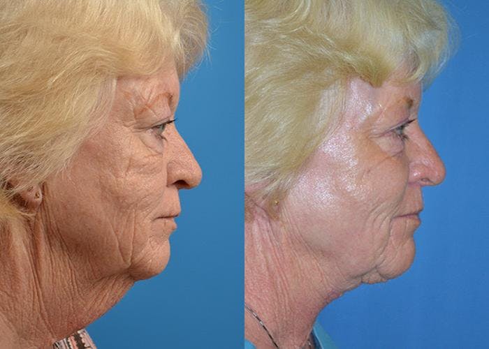Profile Neck Lift Before & After Gallery - Patient 122406444 - Image 2