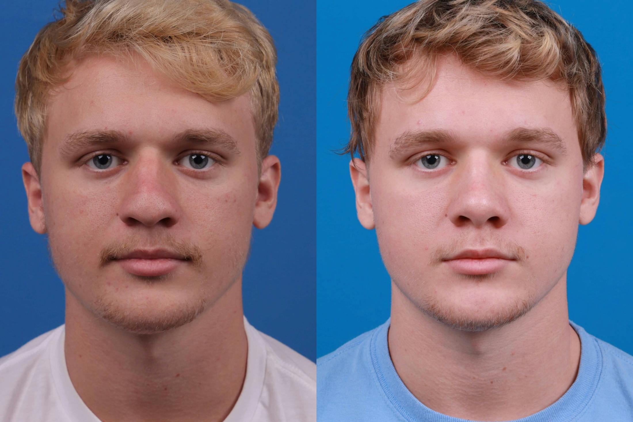 Male Rhinoplasty Before & After Gallery - Patient 122406445 - Image 1