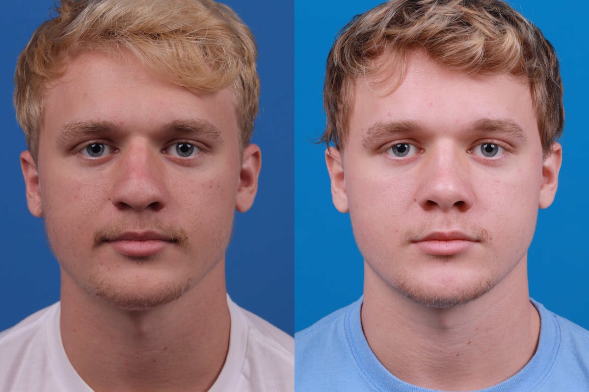 Male Rhinoplasty Before & After Gallery - Patient 122406445 - Image 1