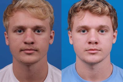 Male Rhinoplasty Before & After Gallery - Patient 122406445 - Image 1