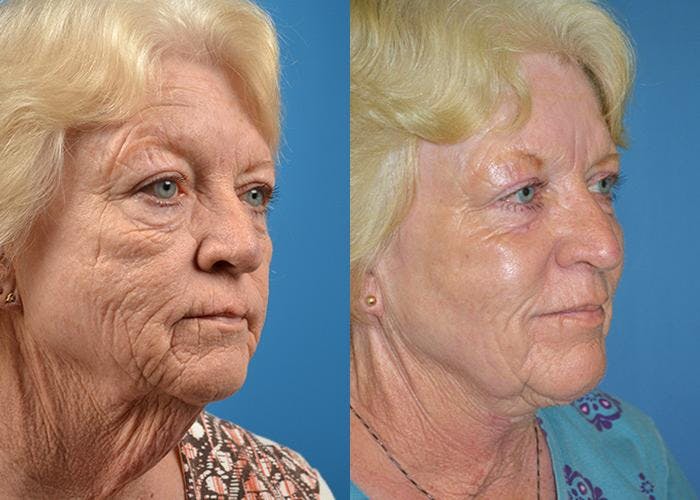 Profile Neck Lift Before & After Gallery - Patient 122406444 - Image 3