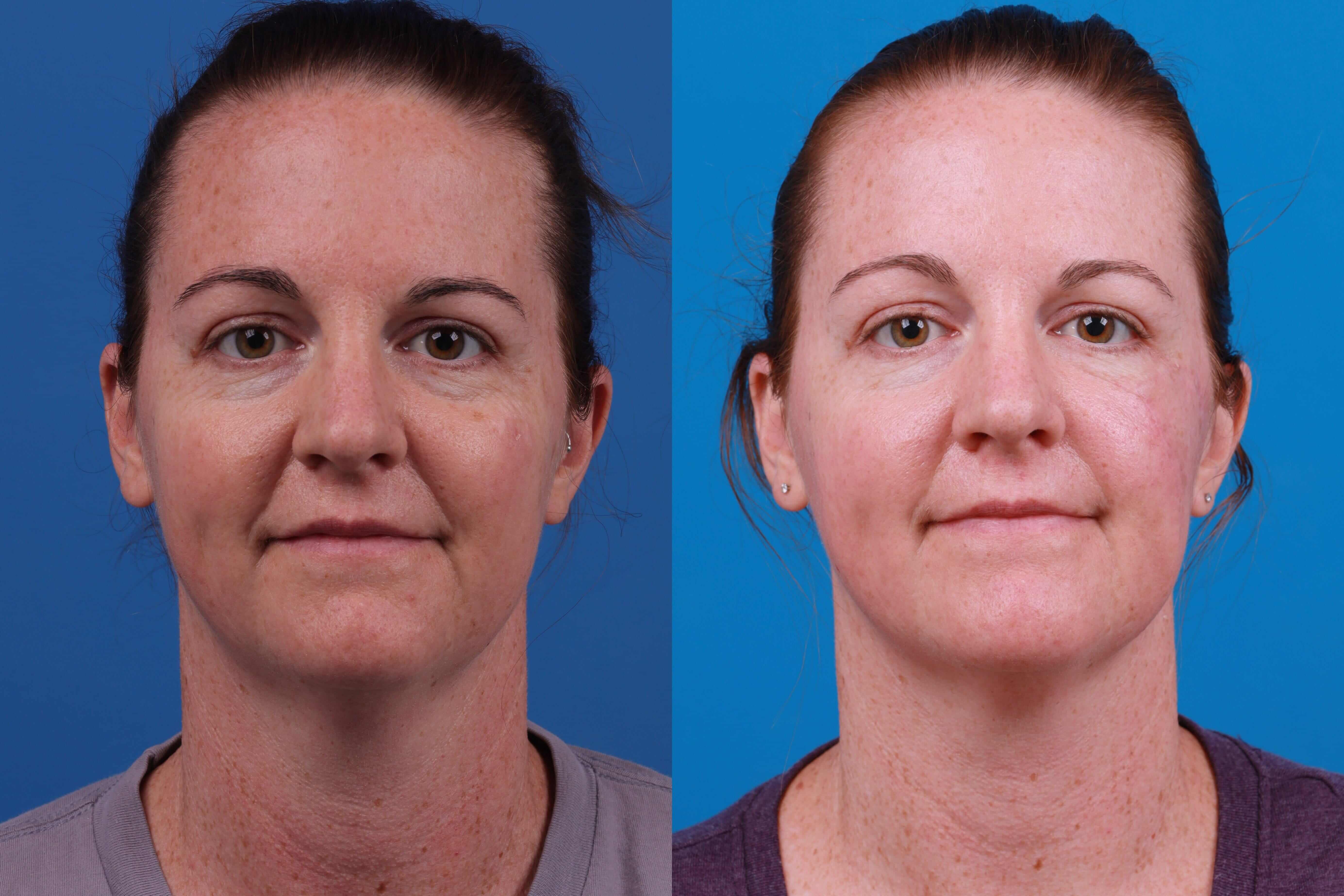 Mohs Surgery and Skin Cancer Before & After Gallery - Patient 122406447 - Image 1